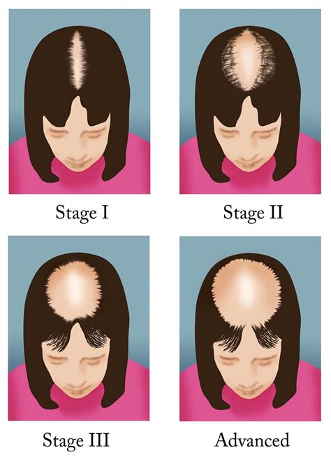 Female Hair Loss hairstyles