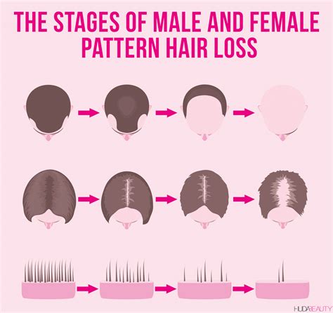 Hair Loss Stages hairstyles