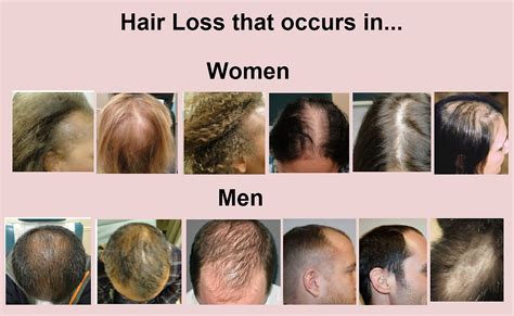 Hair Loss Types hairstyles